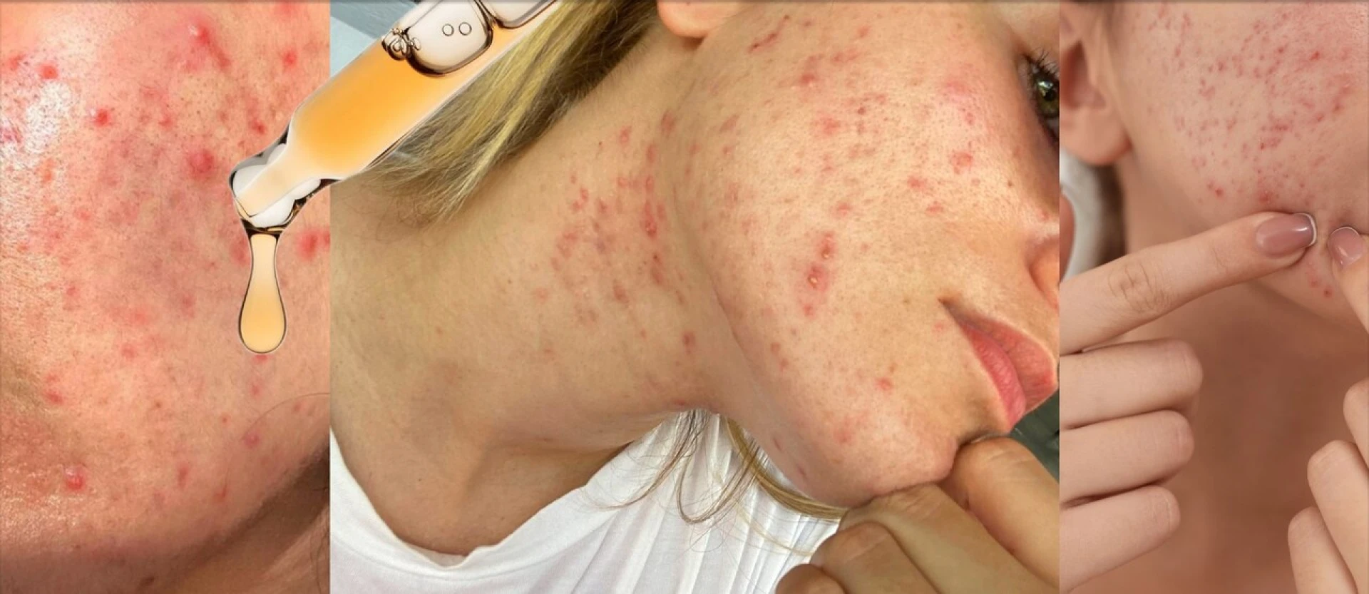 Akné v dospělosti: Proč se objevuje, jak ho řešit a kdy vyhledat odborníka*odbornici