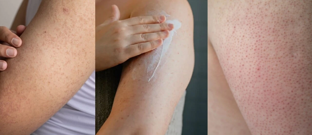 Malé hrbolky, které vypadají jako husí kůže? Možná se jedná o keratosis pilaris a s tím se dá něco dělat