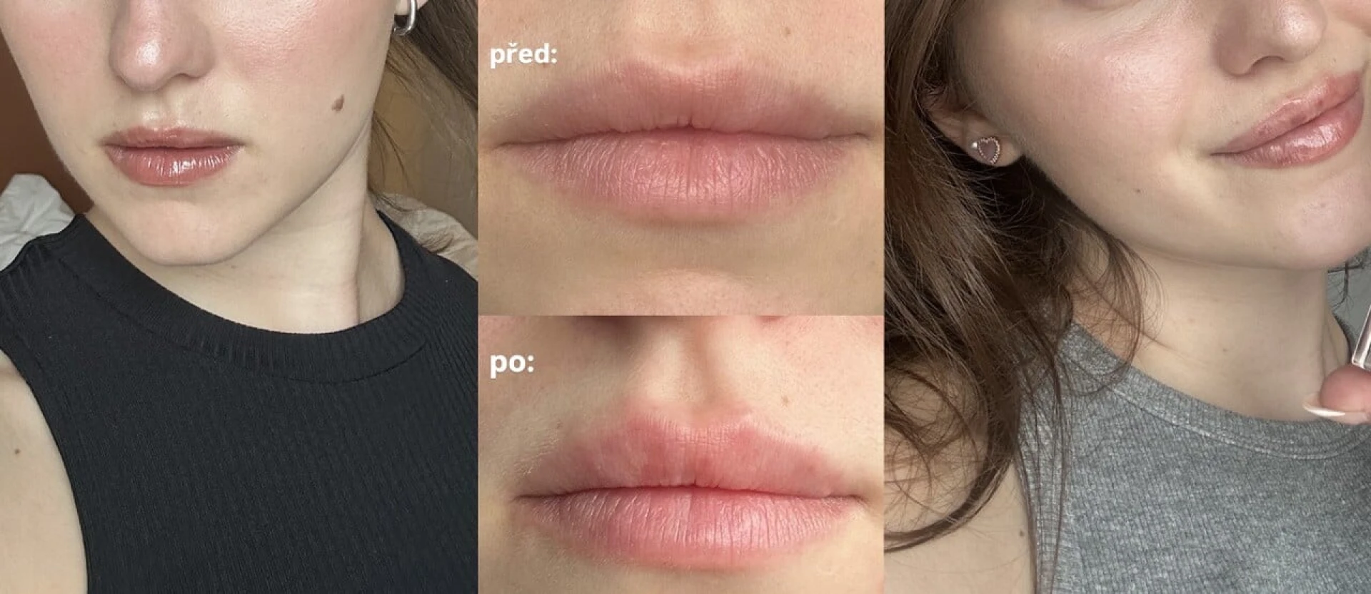 Může výplň rtů kyselinou hyaluronovou škodit zdraví? Zeptali jsme se odborníka