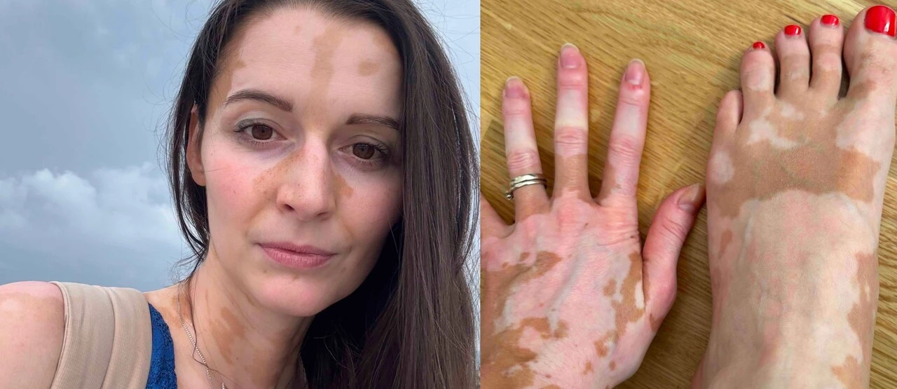 Vitiligo očima ženy, která s ním žije: „Svým způsobem mi ta kůže připadá krásná“